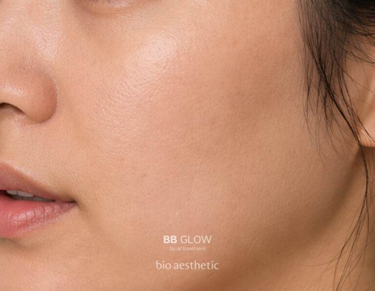 Enlarged-looking pores after