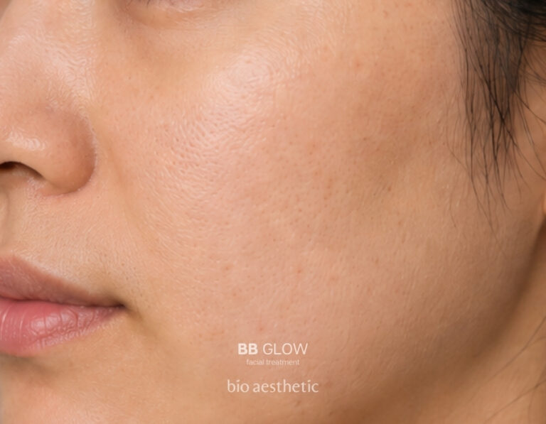 Enlarged-looking pores before