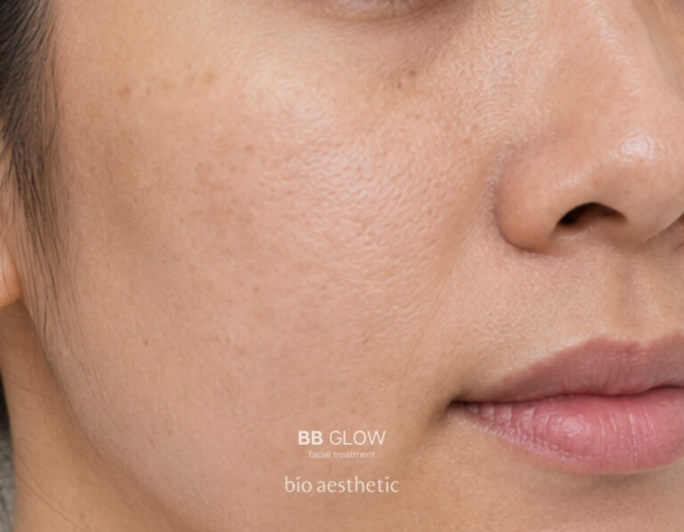 Uneven skin tone before