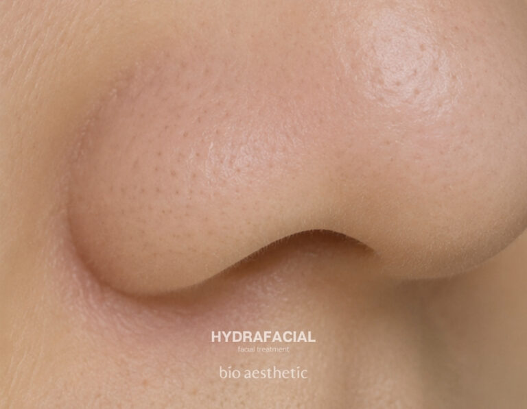 Blackheads and clogged pores after