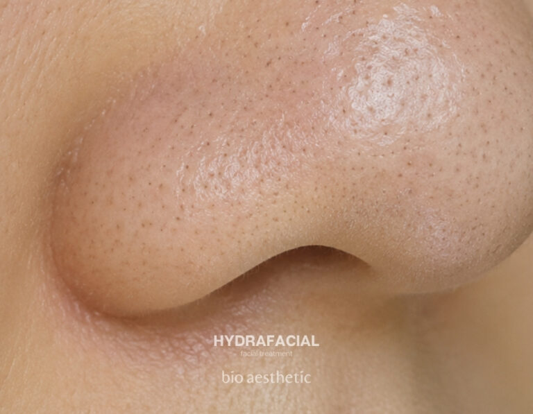 Blackheads and clogged pores before