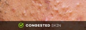 hydrafacial congested skin