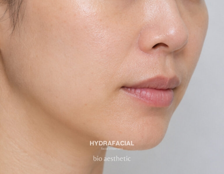 Dull and dehydrated skin after