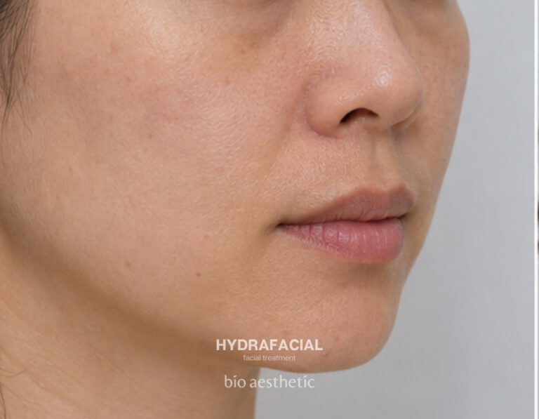 Dull and dehydrated skin before