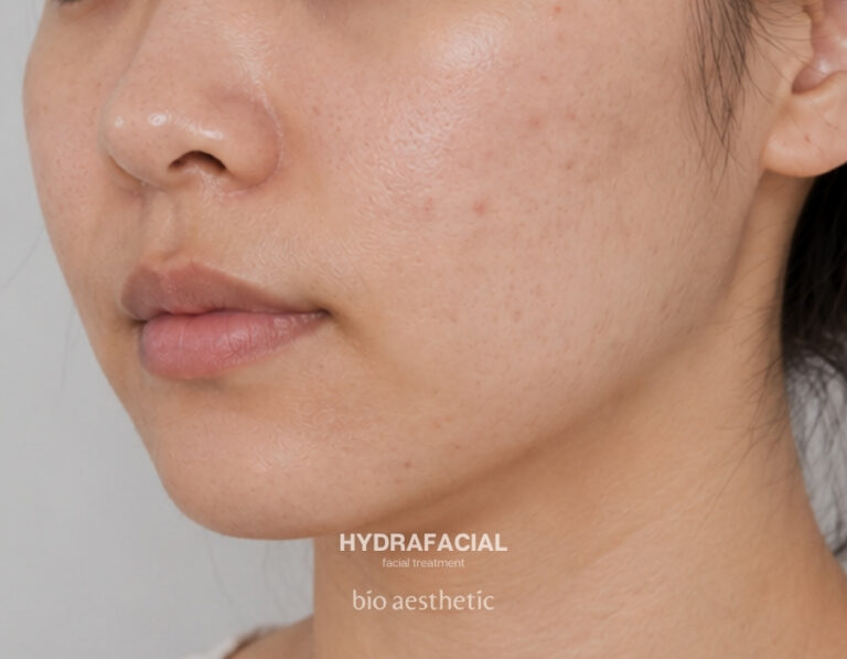 Oily skin after