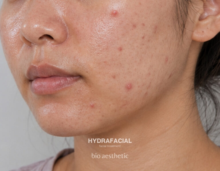 Oily skin before