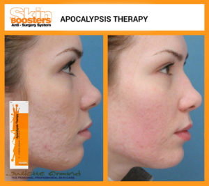 phytopeeling-hulk-acne-therapy