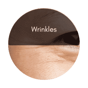 eye lift wrinkles