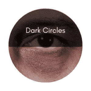 eye lift dark circles