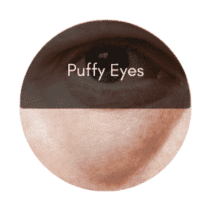 eye lift puffy eyes