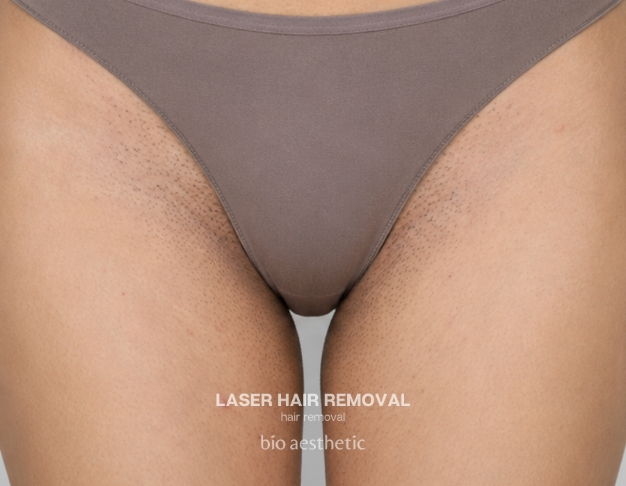 brazilian laser hair removal before and after