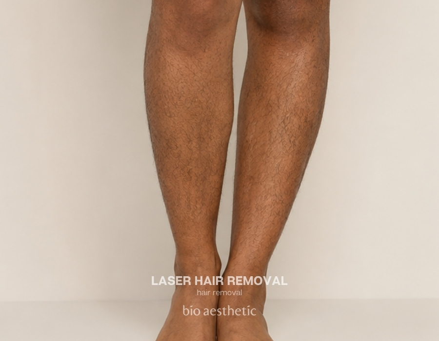 legs laser hair removal before and after