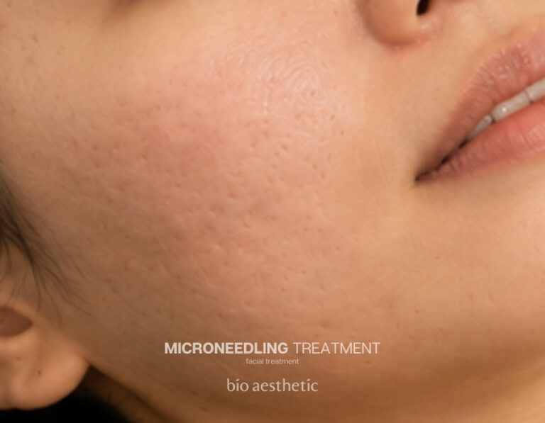 Acne scars after