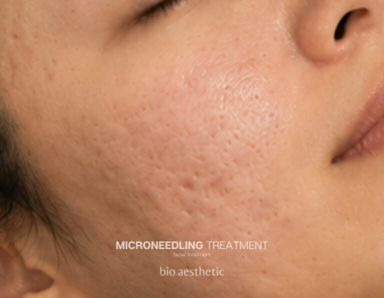 Acne scars before