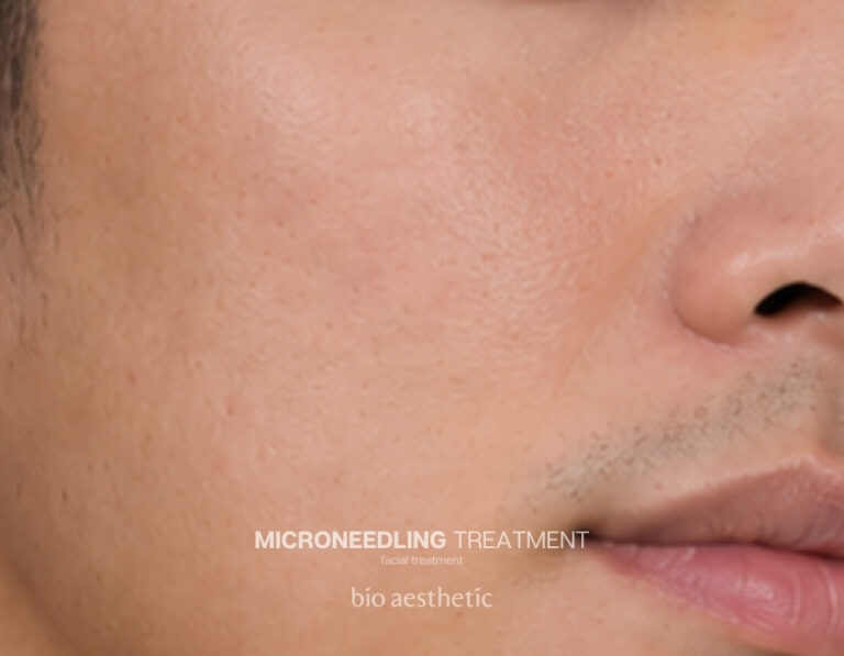 Enlarged pores after