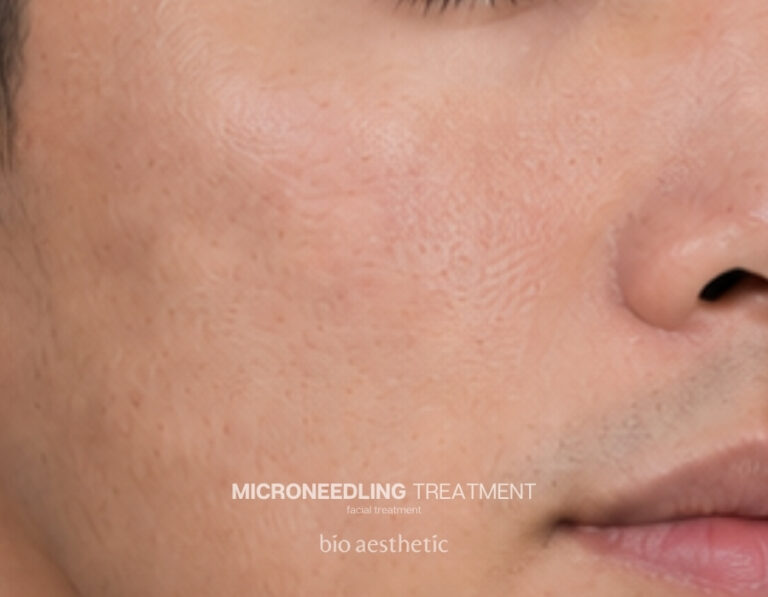 Enlarged pores before
