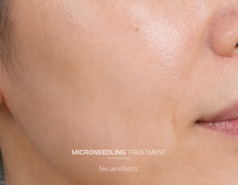 Wrinkles and fine lines after