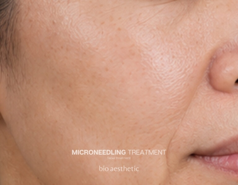 Wrinkles and fine lines before