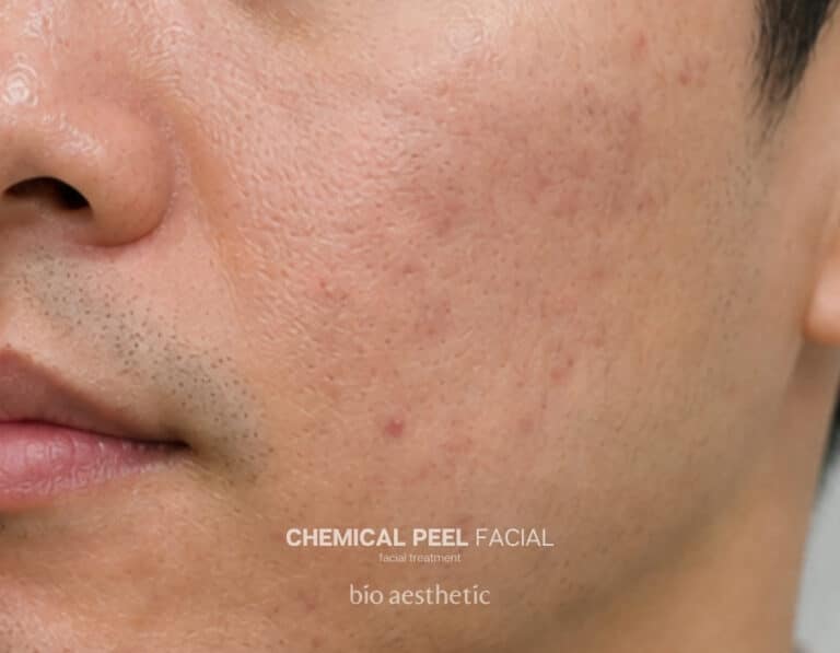 Acne-prone skin after