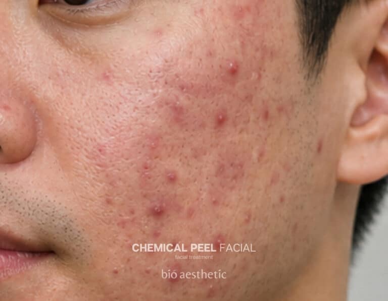Acne-prone skin before