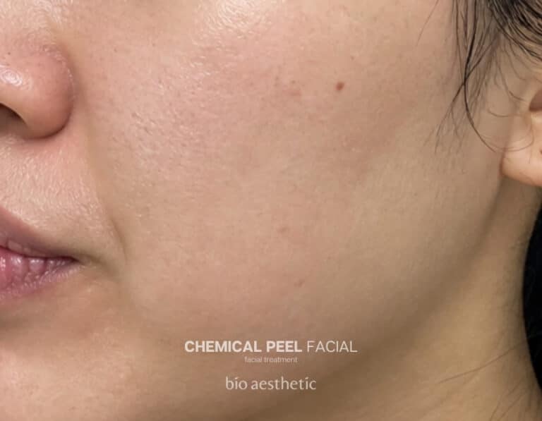 Clogged pores after