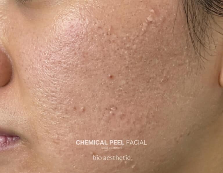 Clogged pores before