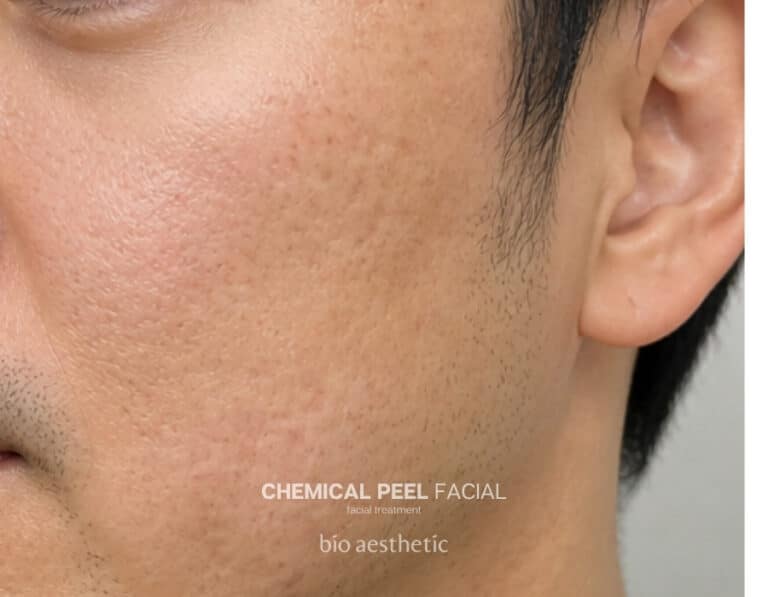 Pigmentation and acne marks after