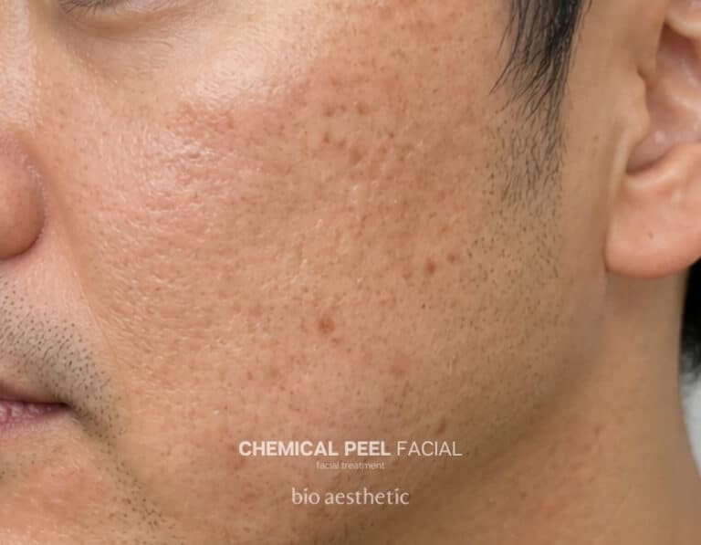 Pigmentation and acne marks before