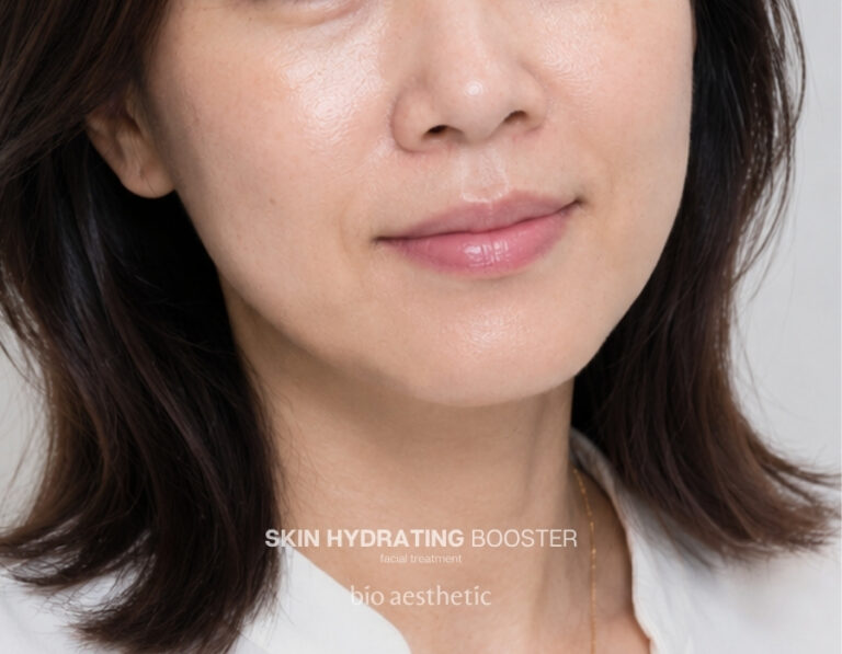 Fine lines after