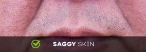 saggy skin