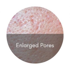 skinbooster enlarged pores