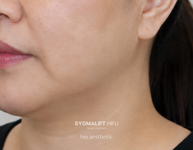 Double chin before