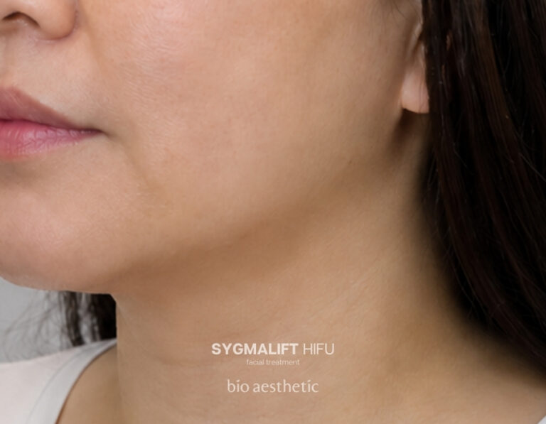 Double chin after