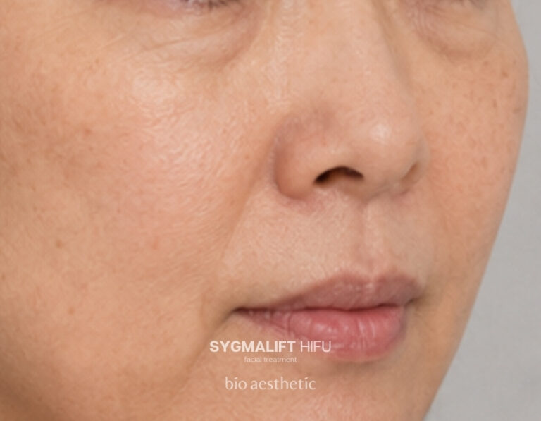 Eye lift before