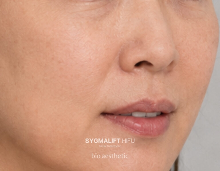 Eye lift after