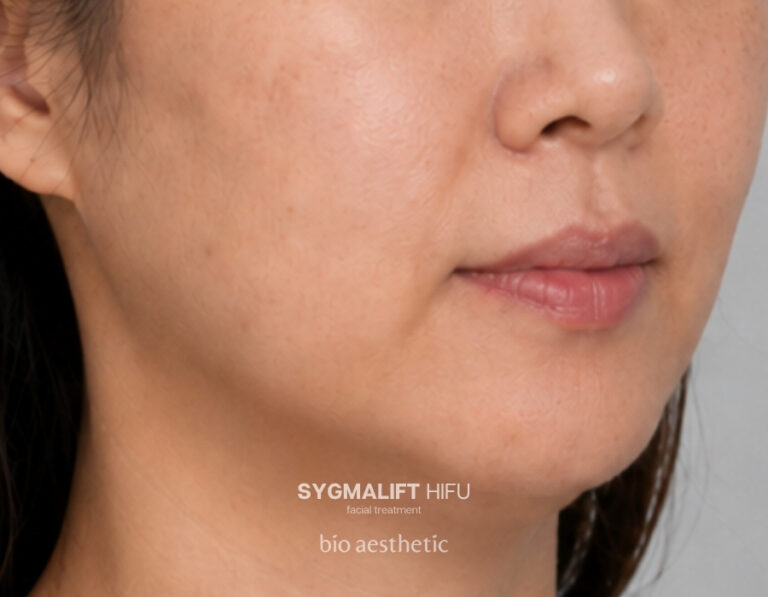 Jawline definition before