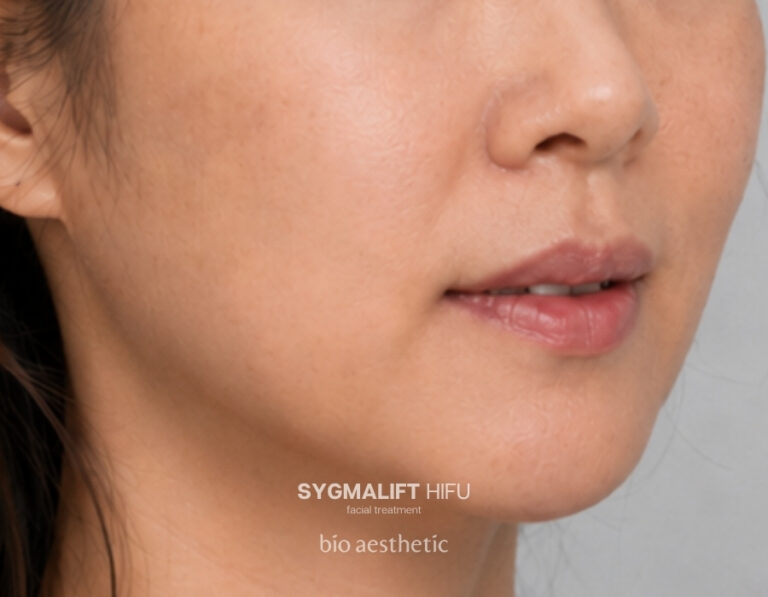 Jawline definition after
