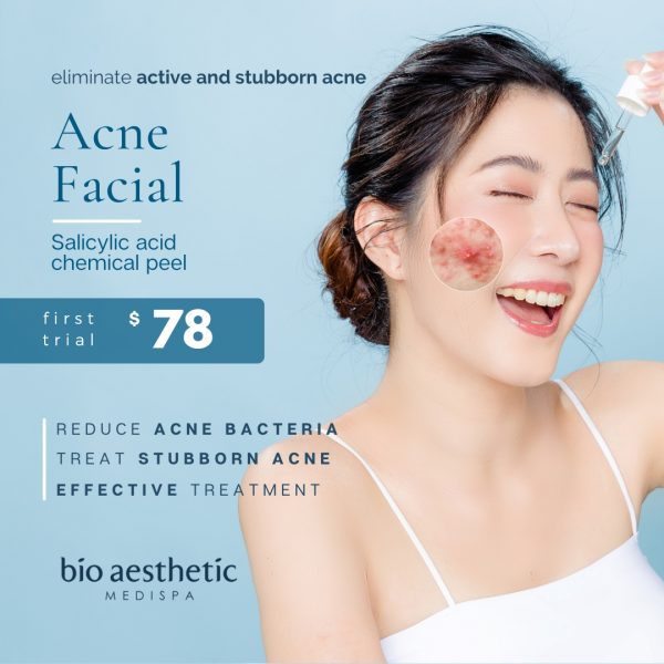 acne facial chemical peel trial promotion