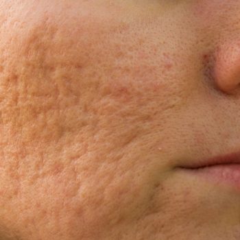 facial treatment acne scars