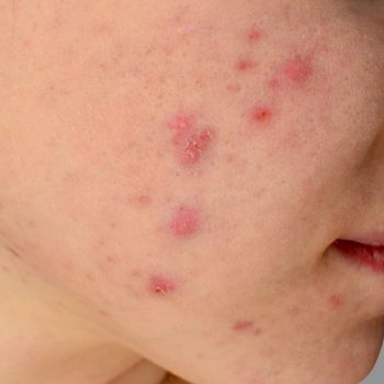 facial treatment acne skin