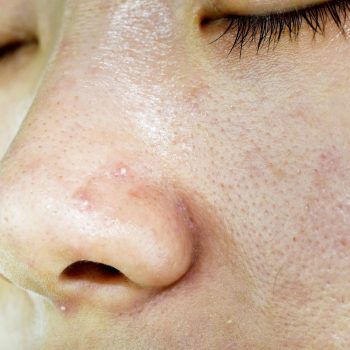 facial treatment oily skin clogged pores