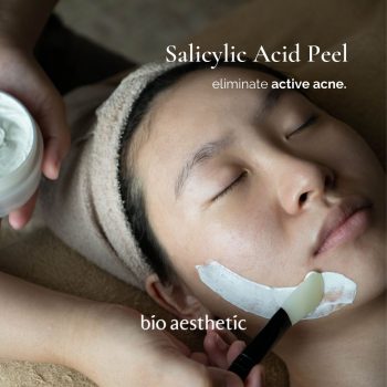 salicylic acid acne facial peel - facial treatment singapore