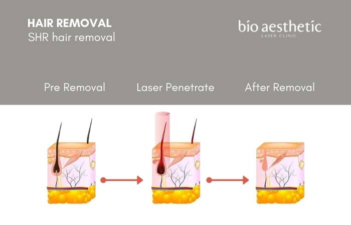 how to shr hair removal work - shr hair removal trial