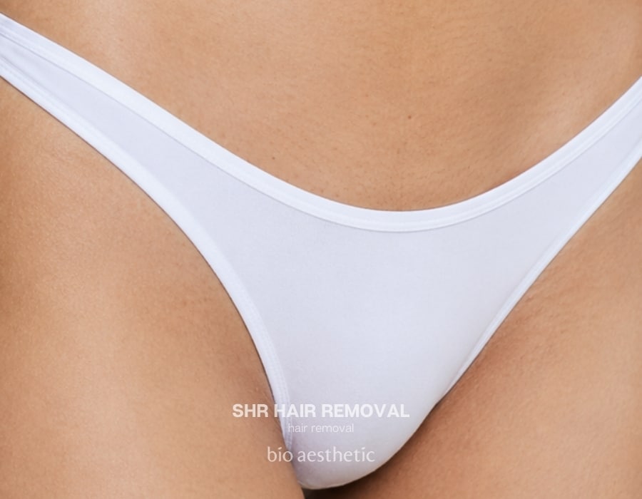 shr hair removal before and after bikini line brazilian 1
