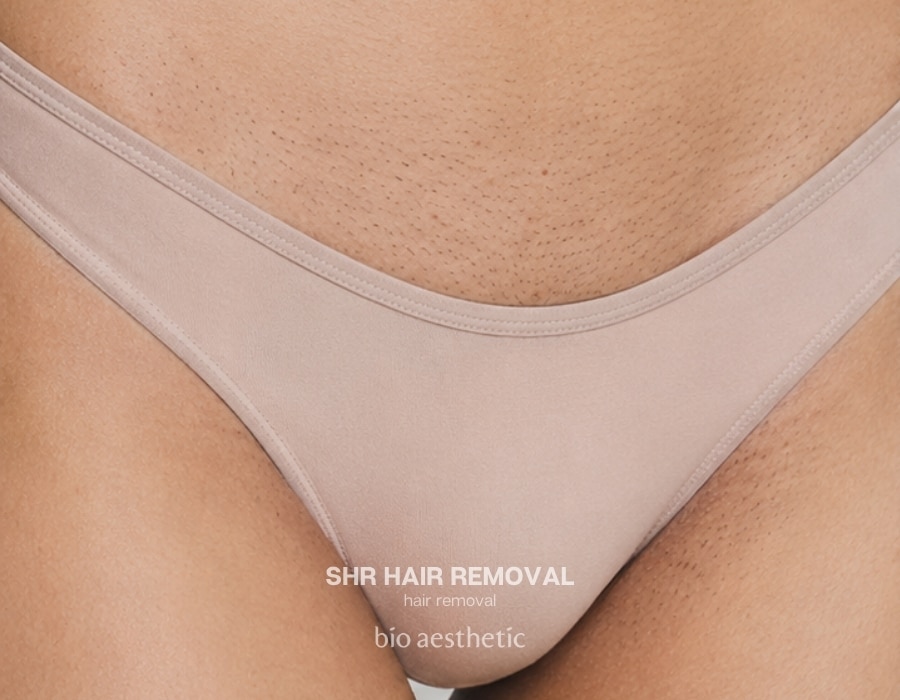 shr hair removal before and after bikini line brazilian