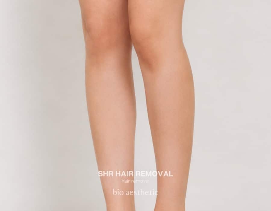 shr hair removal before and after legs 1
