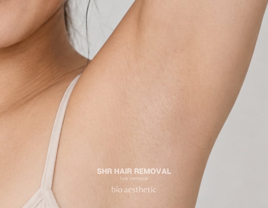 shr hair removal before and after underarm 1