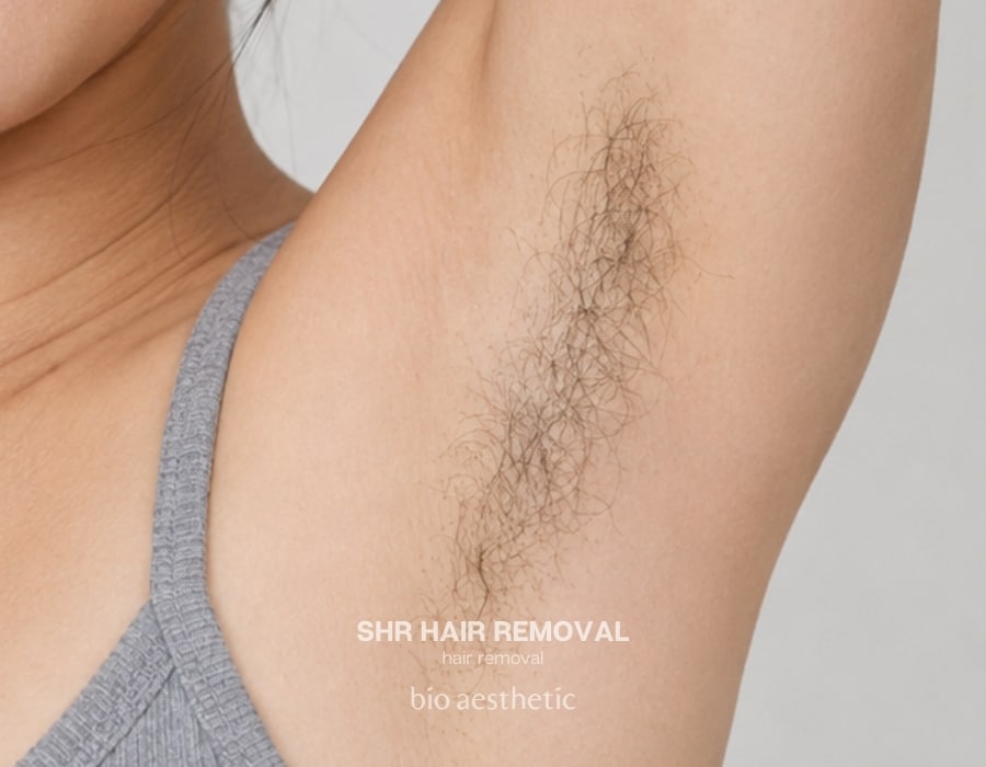 shr hair removal before and after underarm