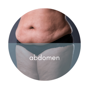 abdomen cellulite