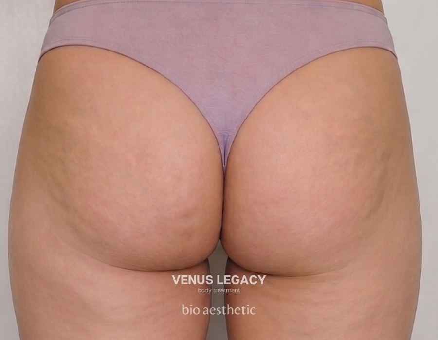 buttock cellulite treatment venus legacy 1